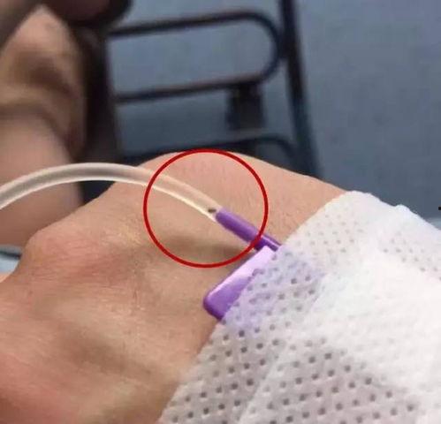 男士挂盐水的真实照片,探寻民间传统疗法的奥秘